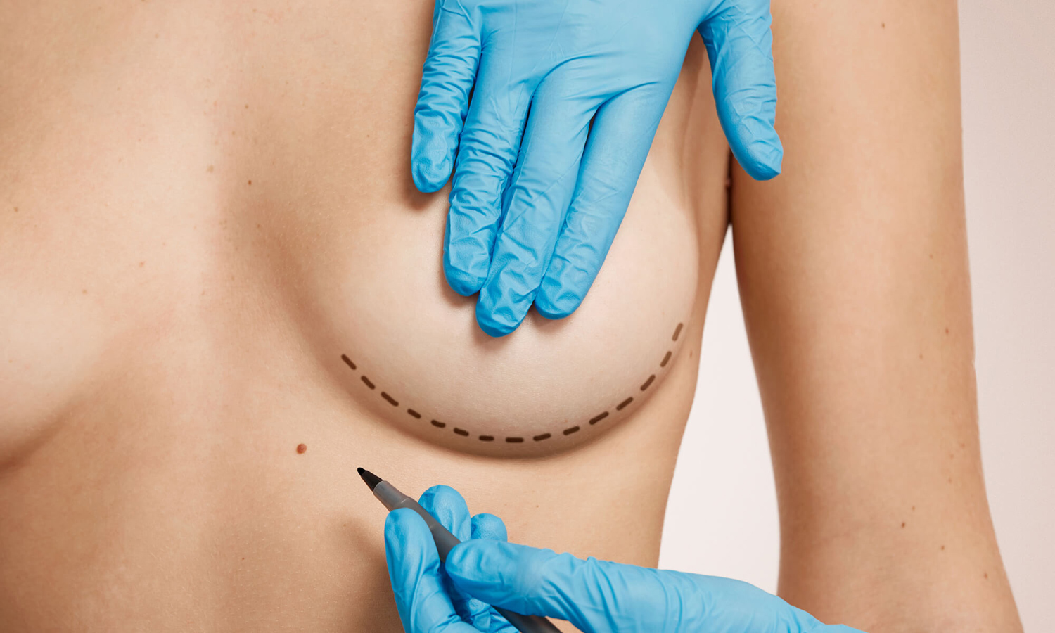 Cirujano plástico haciendo las marcas en un pecho antes de la cirugía